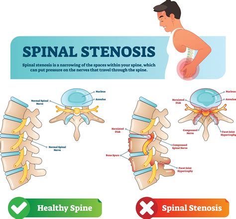 Depending on your condition, those can include Numbness or tingling in the arm or legs Weakness in your arms, legs, or feet Gradual to sudden clumsiness A loss of coordination Difficulty walking Loss of bowel and bladder control Lower back pain Neck pain. . Can ms be mistaken for spinal stenosis